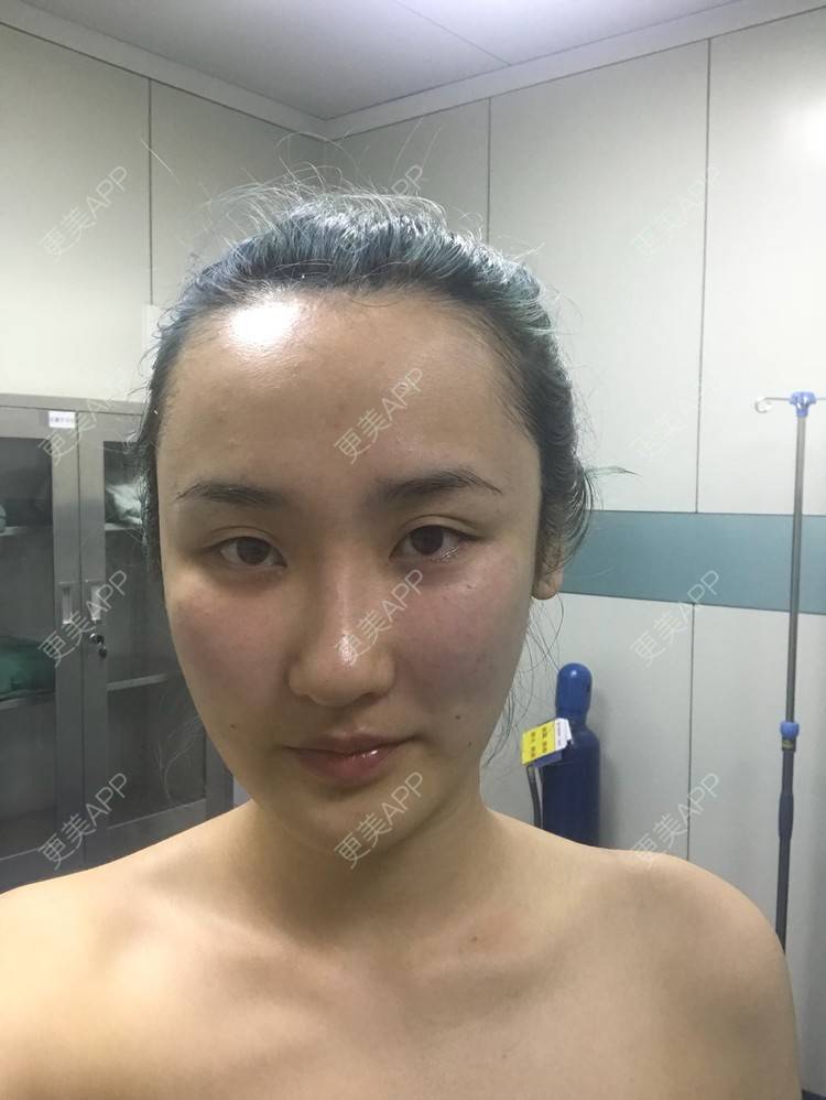 更美 - 哒哒#的自体脂肪填充泪沟经验 | 自体脂肪面部填充 | 自体脂肪填充泪沟 | 自体脂肪填充面部细纹