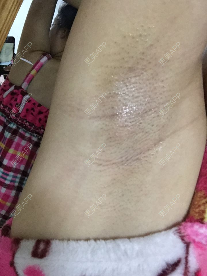 更美用户tjyg0wlvmq的激光脱腋毛日记