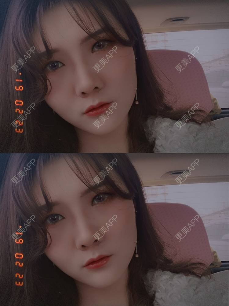 更美 - 奇葩小女王___的鼻部多项经验 | 鼻部多项 | 硅胶隆鼻 | 肋软骨隆鼻 | 郑州 | 自体肋软骨垫鼻基底