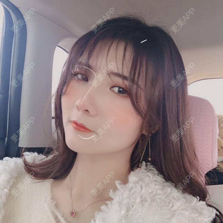 更美 - 奇葩小女王___的鼻部多项经验 | 鼻部多项 | 硅胶隆鼻 | 肋软骨隆鼻 | 郑州 | 自体肋软骨垫鼻基底