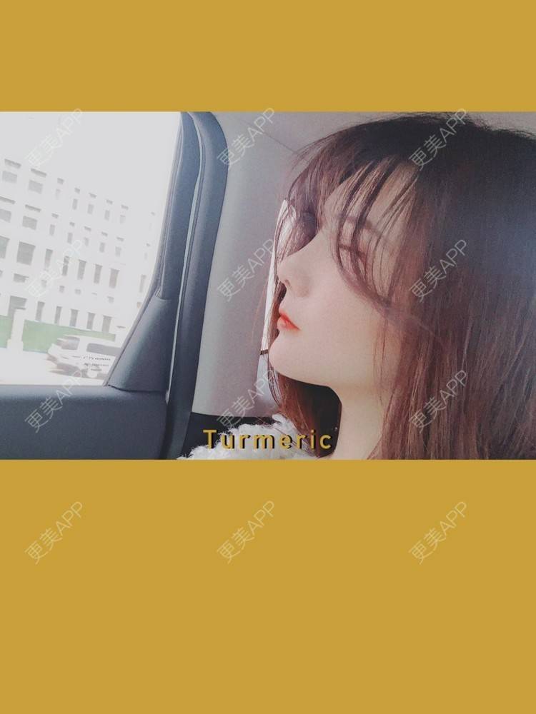 更美 - 奇葩小女王___的鼻部多项经验 | 鼻部多项 | 硅胶隆鼻 | 肋软骨隆鼻 | 郑州 | 自体肋软骨垫鼻基底