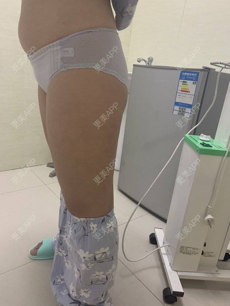 更美 - 凑热闹的逗比的吸脂瘦大腿经验 | 吸脂瘦大腿 | 黄冈