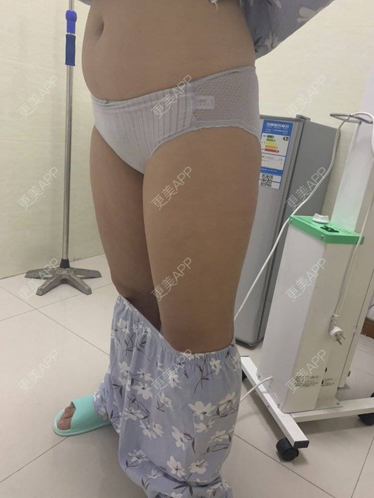 更美 - 凑热闹的逗比的吸脂瘦大腿经验 | 吸脂瘦大腿 | 黄冈