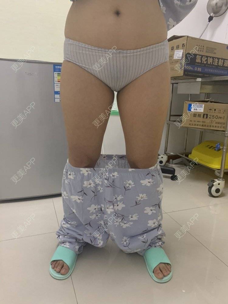 更美 - 凑热闹的逗比的吸脂瘦大腿经验 | 吸脂瘦大腿 | 黄冈