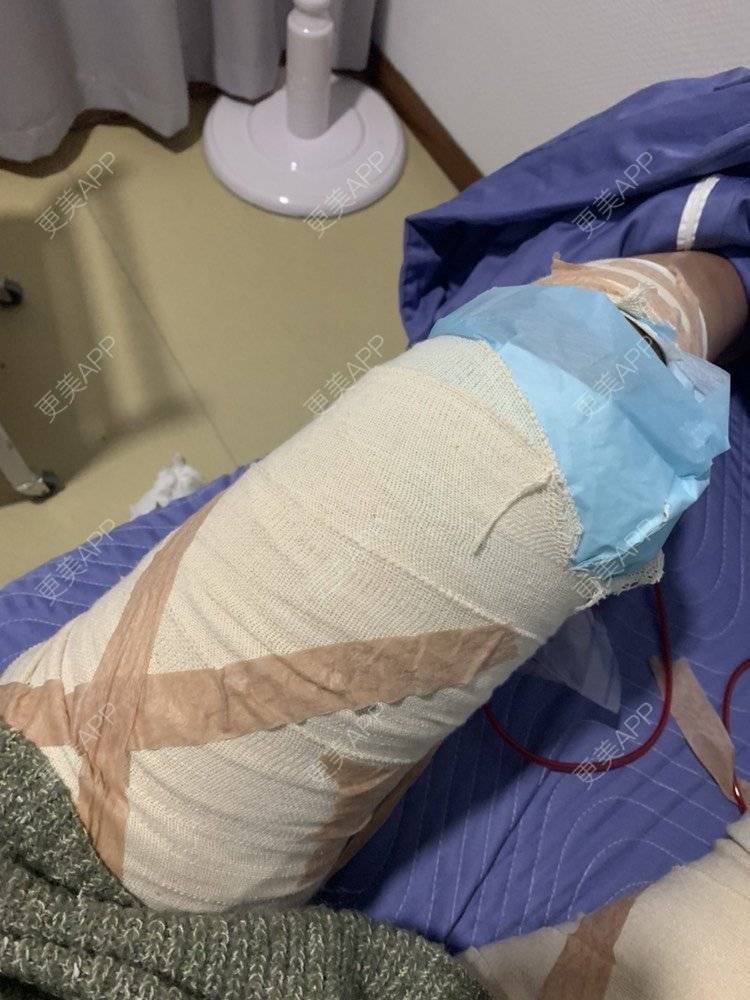 更美 - 凑热闹的逗比的吸脂瘦大腿经验 | 吸脂瘦大腿 | 黄冈