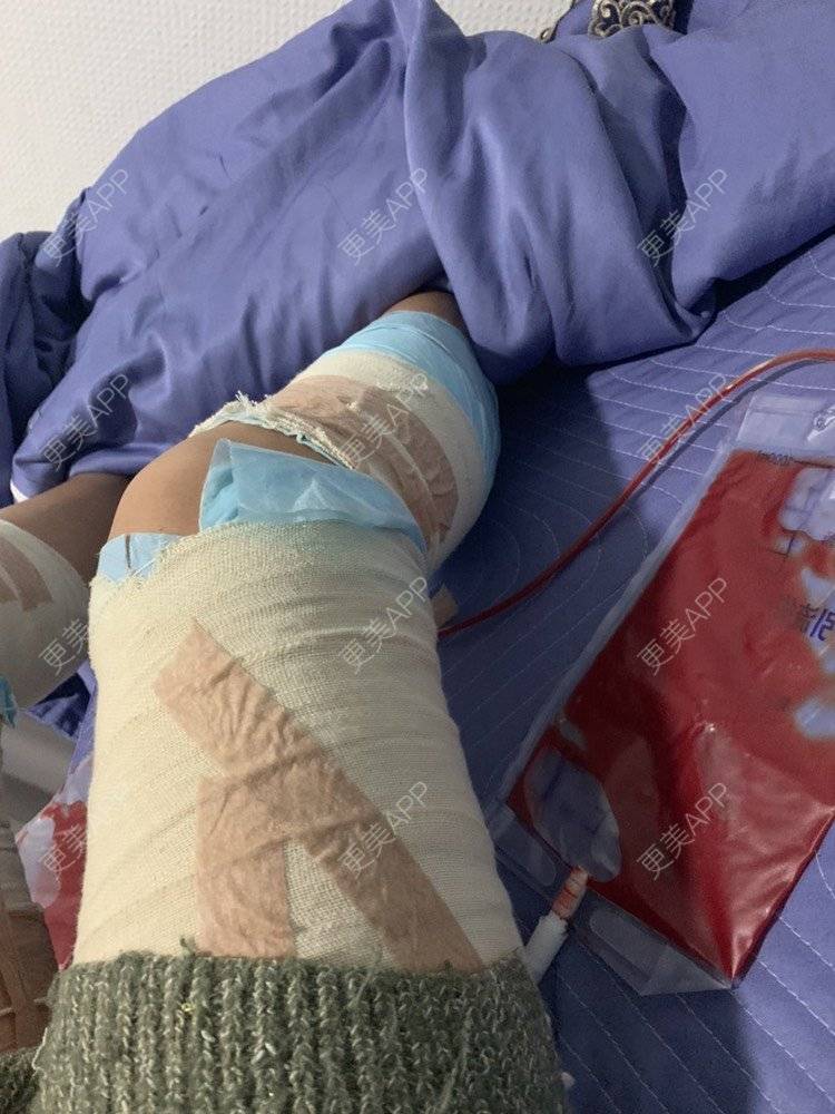 更美 - 凑热闹的逗比的吸脂瘦大腿经验 | 吸脂瘦大腿 | 黄冈