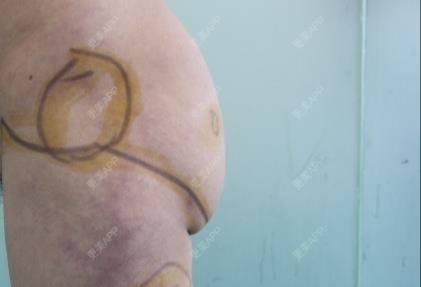 更美 - 更美用户HQBIGvzJpC的自体脂肪丰臀经验 | 自体脂肪丰臀 | 郑州