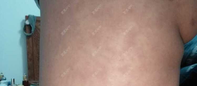 更美 - 更美用户HQBIGvzJpC的自体脂肪丰臀经验 | 自体脂肪丰臀 | 郑州