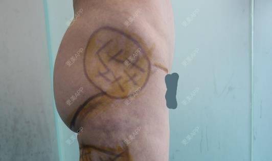 更美 - 更美用户HQBIGvzJpC的自体脂肪丰臀经验 | 自体脂肪丰臀 | 郑州