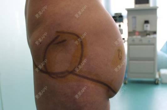 更美 - 更美用户HQBIGvzJpC的自体脂肪丰臀经验 | 自体脂肪丰臀 | 郑州