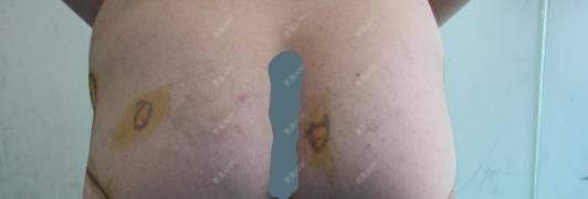 更美 - 更美用户HQBIGvzJpC的自体脂肪丰臀经验 | 自体脂肪丰臀 | 郑州