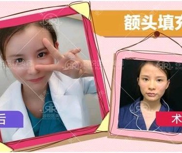 自体脂肪面部填充