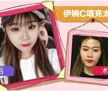 自体脂肪面部填充