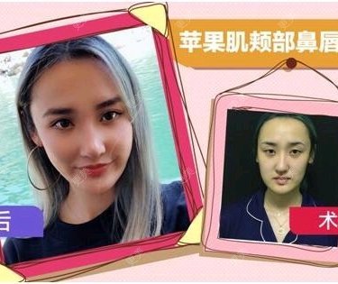 自体脂肪面部填充