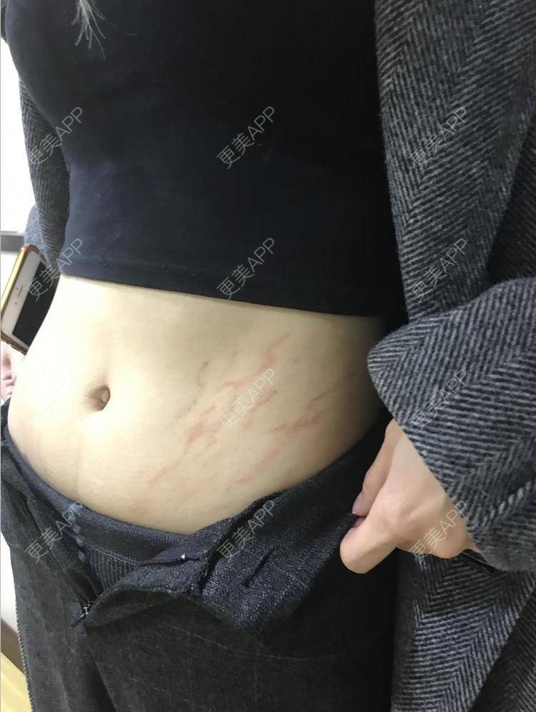 更美 - 光影~宇的妊娠纹经验 | 微针淡化妊娠纹 | 妊娠纹 | 激光淡化妊娠纹 | 成都