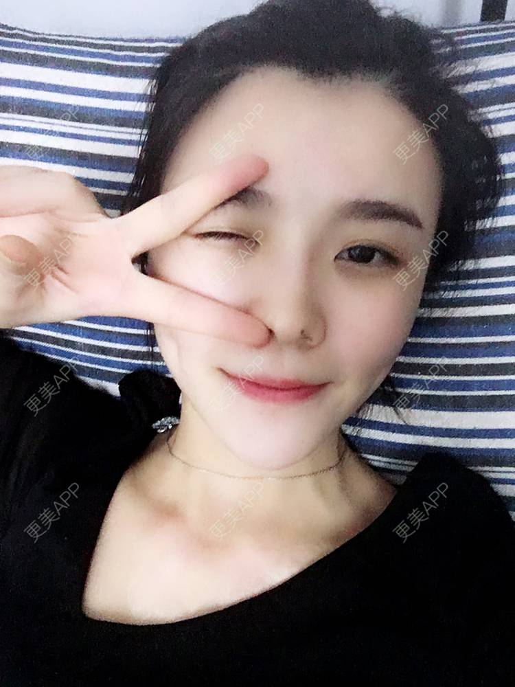 更美 - 留海君的玻尿酸眉弓经验 | 玻尿酸太阳穴 | 玻尿酸泪沟 | 玻尿酸眉弓 | 广州