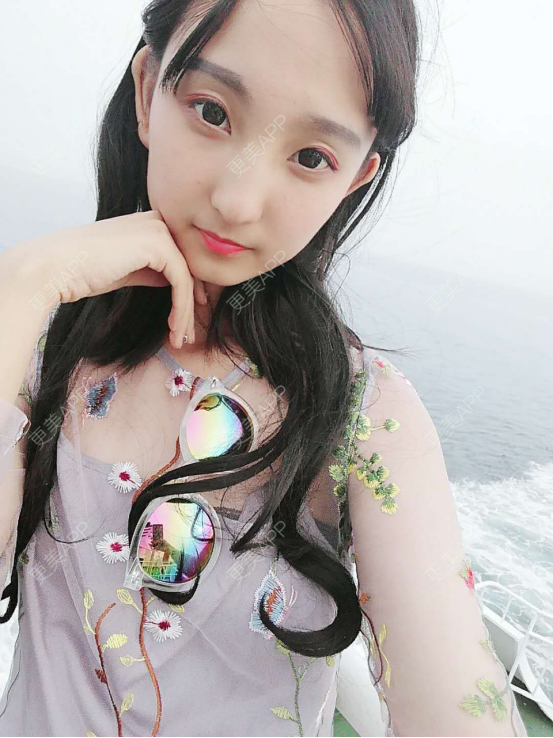 更美 - 银川田永成医学美容有限责任公司田永成医学美容门诊部的祛眼袋经验 | 祛眼袋