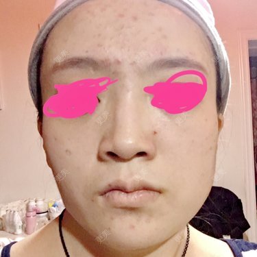 面部不对称矫正