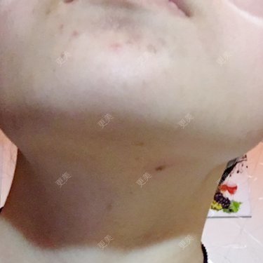 面部不对称矫正