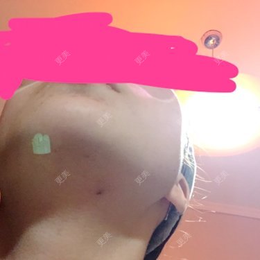 面部不对称矫正