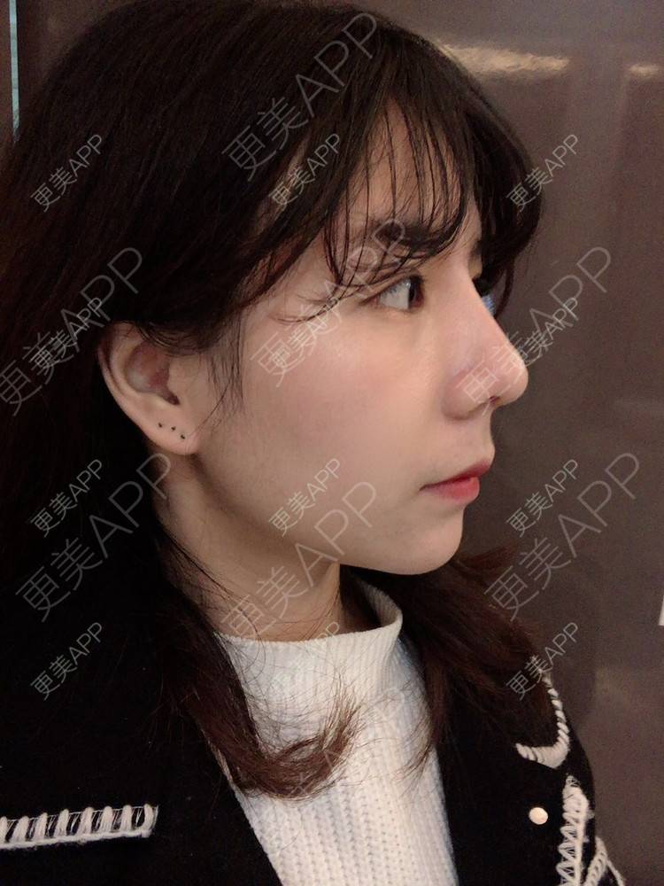 更美 - 看到你就逃的鼻部多项经验 | 手术缩鼻头 | 鼻部多项 | 杭州 | 鼻小柱延长