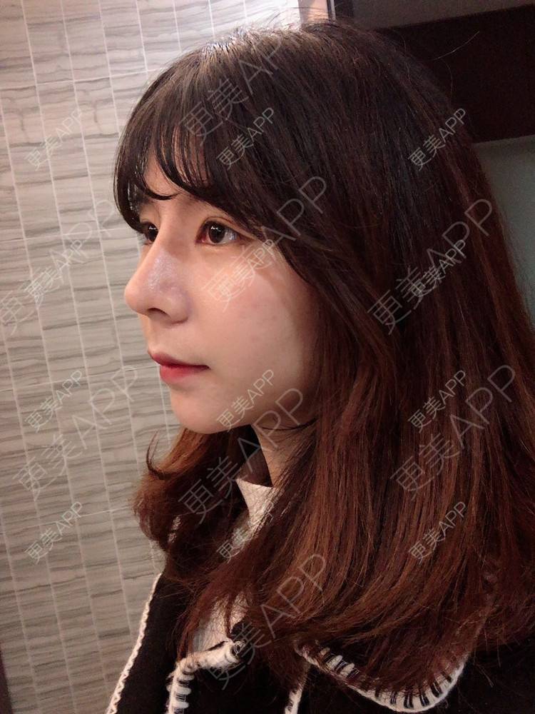 更美 - 看到你就逃的鼻部多项经验 | 手术缩鼻头 | 鼻部多项 | 杭州 | 鼻小柱延长