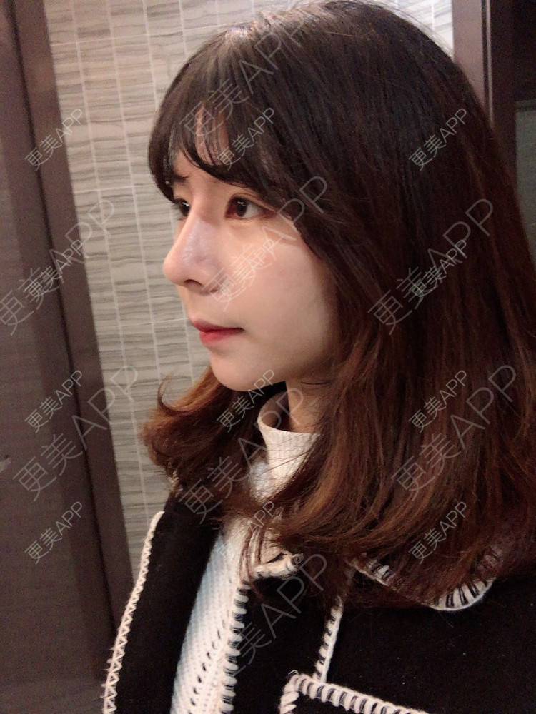 更美 - 看到你就逃的鼻部多项经验 | 手术缩鼻头 | 鼻部多项 | 杭州 | 鼻小柱延长