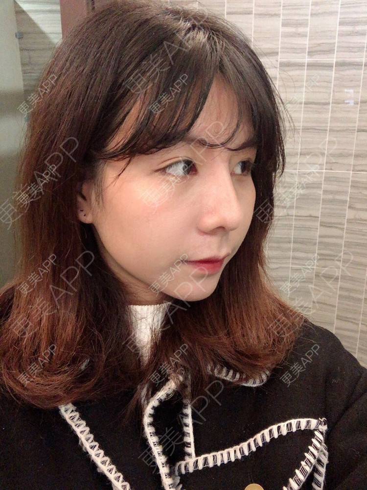 更美 - 看到你就逃的鼻部多项经验 | 手术缩鼻头 | 鼻部多项 | 杭州 | 鼻小柱延长