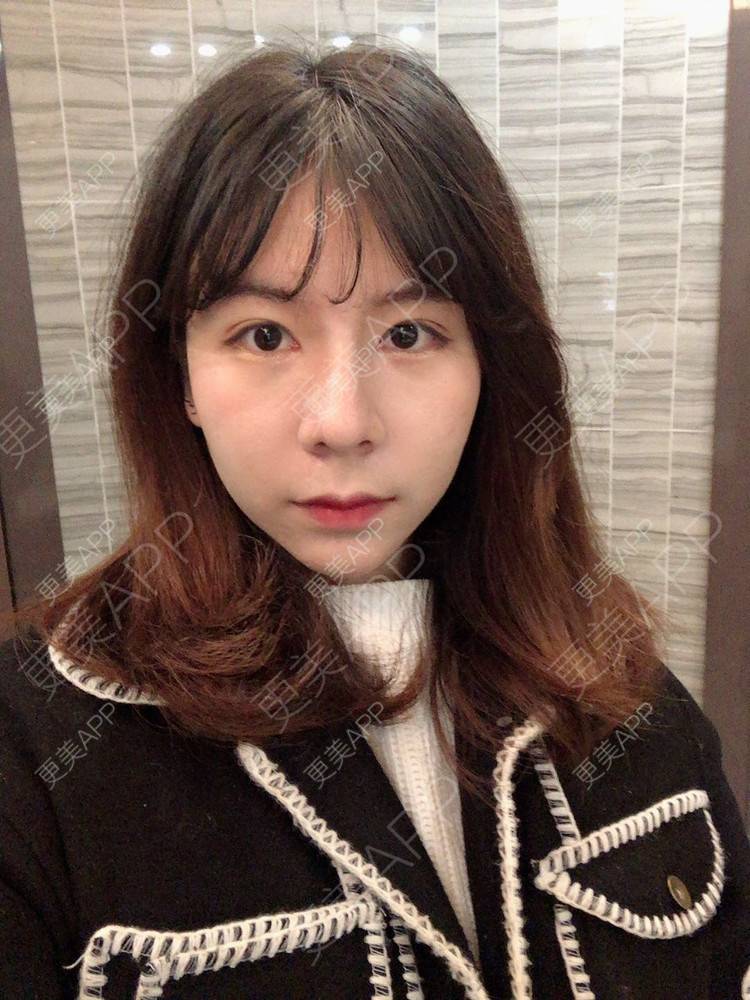 更美 - 看到你就逃的鼻部多项经验 | 手术缩鼻头 | 鼻部多项 | 杭州 | 鼻小柱延长