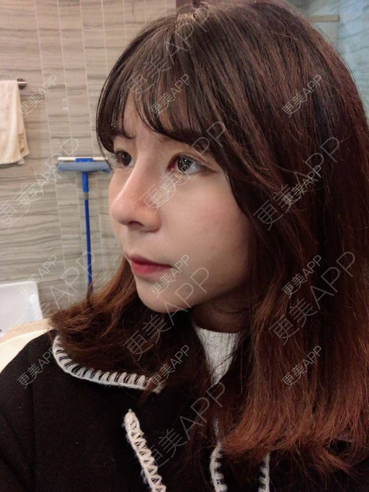 更美 - 看到你就逃的鼻部多项经验 | 手术缩鼻头 | 鼻部多项 | 杭州 | 鼻小柱延长