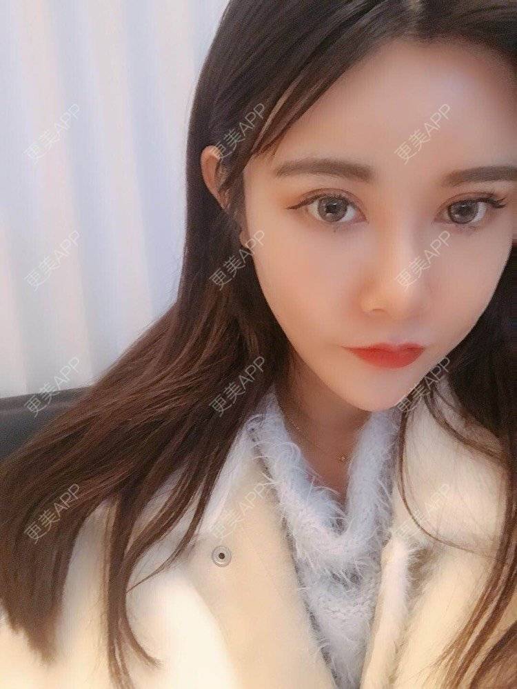 更美 - 饼干掉了的自体脂肪丰苹果肌经验 | 自体脂肪丰苹果肌 | 自体脂肪垫下巴 | 自体脂肪丰太阳穴 | 自体脂肪丰额头 | 自体脂肪全面部填充 | 杭州