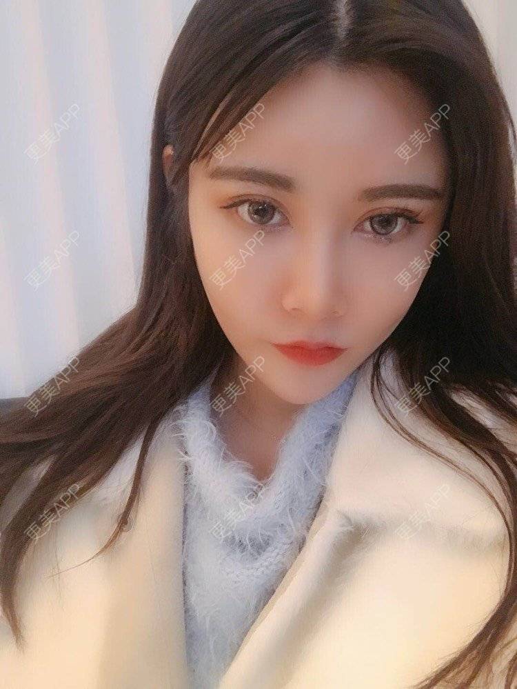 更美 - 饼干掉了的自体脂肪丰苹果肌经验 | 自体脂肪丰苹果肌 | 自体脂肪垫下巴 | 自体脂肪丰太阳穴 | 自体脂肪丰额头 | 自体脂肪全面部填充 | 杭州