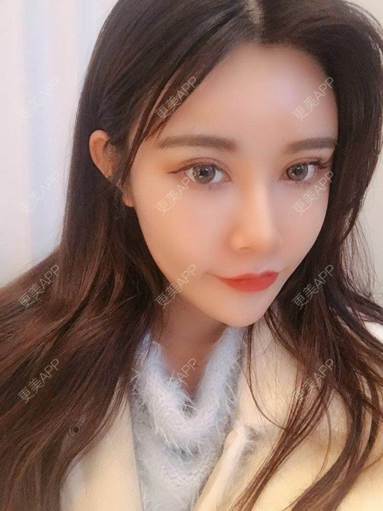 更美 - 饼干掉了的自体脂肪丰苹果肌经验 | 自体脂肪丰苹果肌 | 自体脂肪垫下巴 | 自体脂肪丰太阳穴 | 自体脂肪丰额头 | 自体脂肪全面部填充 | 杭州