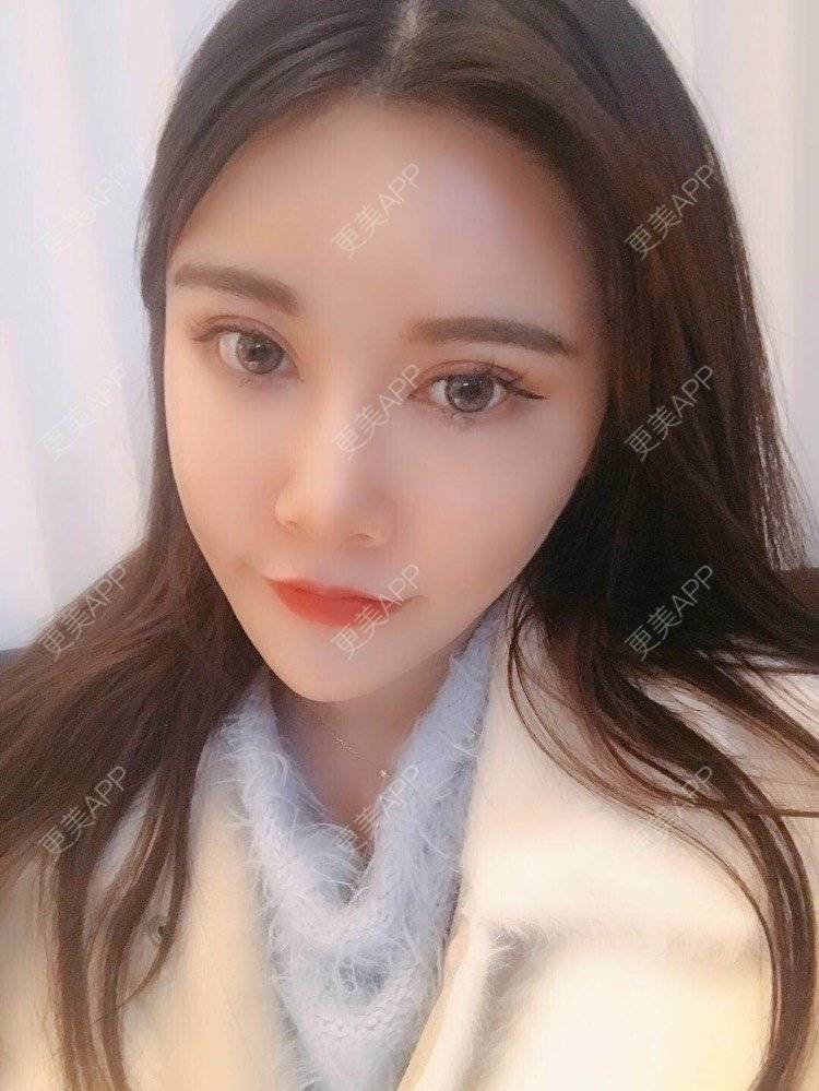 更美 - 饼干掉了的自体脂肪丰苹果肌经验 | 自体脂肪丰苹果肌 | 自体脂肪垫下巴 | 自体脂肪丰太阳穴 | 自体脂肪丰额头 | 自体脂肪全面部填充 | 杭州