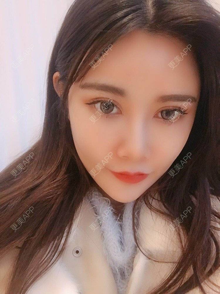 更美 - 饼干掉了的自体脂肪丰苹果肌经验 | 自体脂肪丰苹果肌 | 自体脂肪垫下巴 | 自体脂肪丰太阳穴 | 自体脂肪丰额头 | 自体脂肪全面部填充 | 杭州