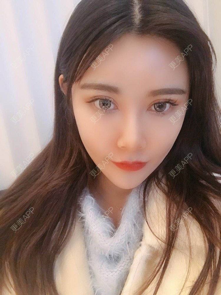 更美 - 饼干掉了的自体脂肪丰苹果肌经验 | 自体脂肪丰苹果肌 | 自体脂肪垫下巴 | 自体脂肪丰太阳穴 | 自体脂肪丰额头 | 自体脂肪全面部填充 | 杭州