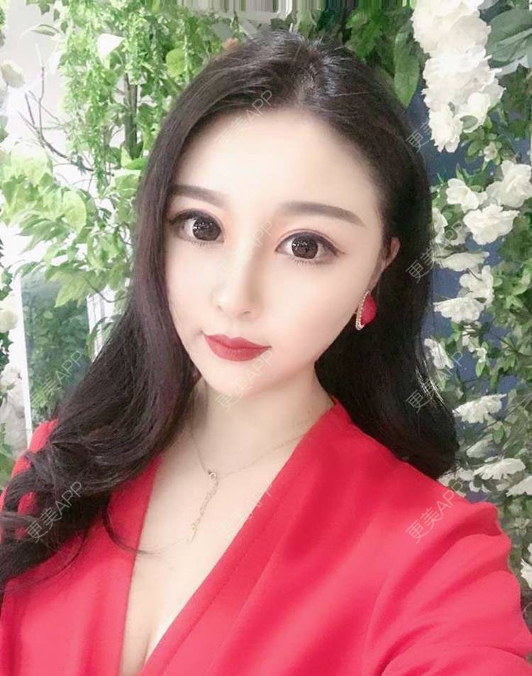 更美 - 更美用户RMdGuoidr7的双下巴吸脂经验 | 双下巴吸脂 | 沈阳