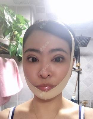 更美 - 青冘泻讨的吸脂经验 | 双下巴吸脂 | 吸脂瘦脸 | 吸脂 | 贵阳