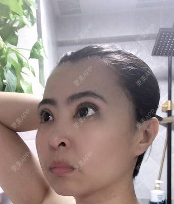 更美 - 青冘泻讨的吸脂经验 | 双下巴吸脂 | 吸脂瘦脸 | 吸脂 | 贵阳
