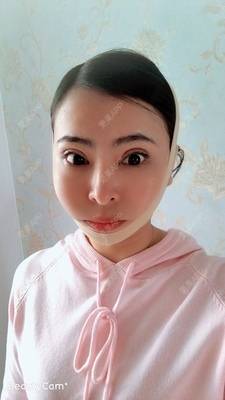 更美 - 青冘泻讨的吸脂经验 | 双下巴吸脂 | 吸脂瘦脸 | 吸脂 | 贵阳