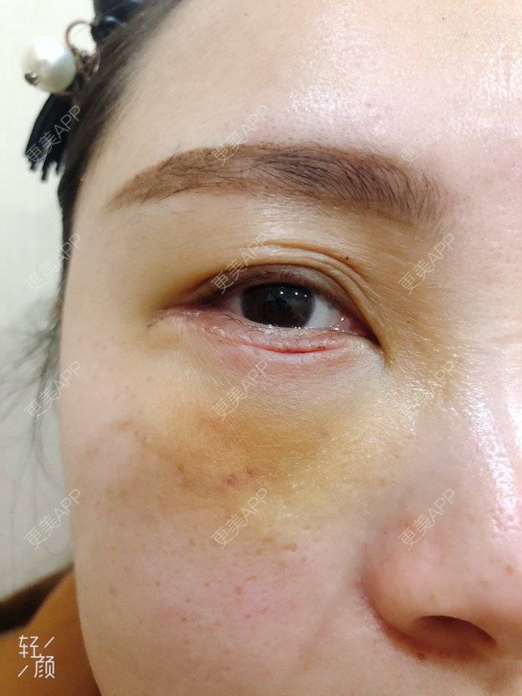 更美用户aodkcagt1m的外切去眼袋日记