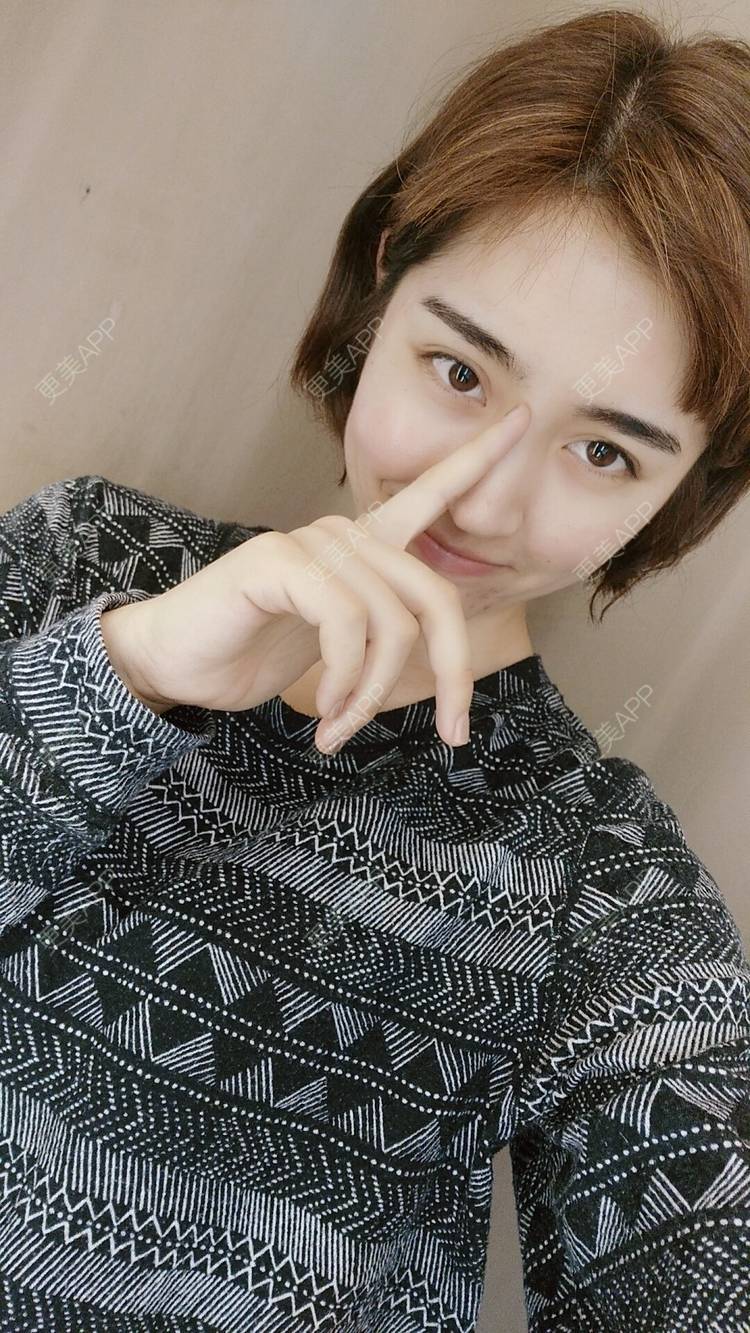 更美 - 更美用户6rYvOEJ1HO的驼峰鼻矫正经验 | 视频日记 | 驼峰鼻矫正