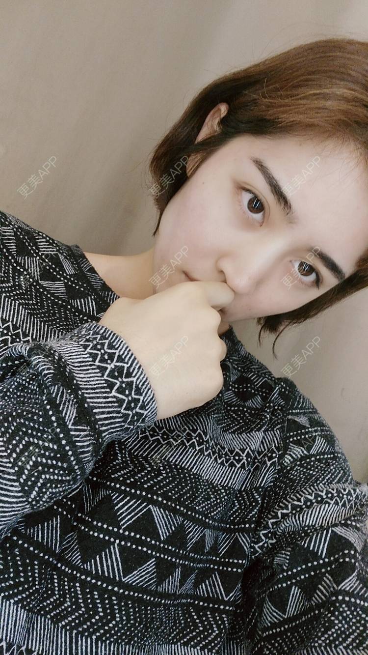 更美 - 更美用户6rYvOEJ1HO的驼峰鼻矫正经验 | 视频日记 | 驼峰鼻矫正