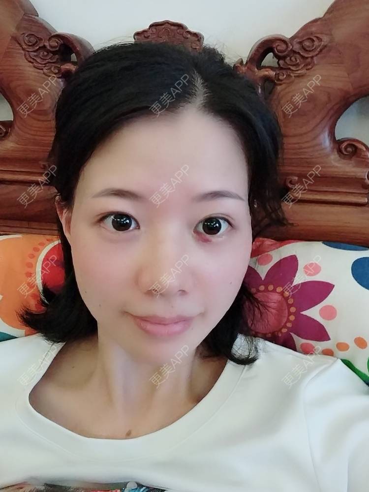 更美 - 更美用户1uRzE9prdE的激光去眼袋经验 | 激光去眼袋 | 广州