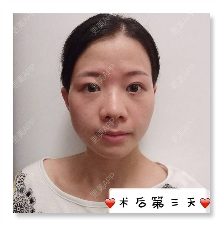 更美 - 更美用户1uRzE9prdE的激光去眼袋经验 | 激光去眼袋 | 广州