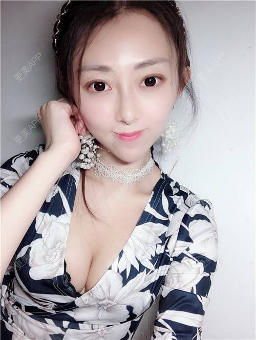 更美 - 花花小可爱的自体脂肪隆胸经验 | 自体脂肪隆胸 | 广州