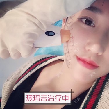 热玛吉