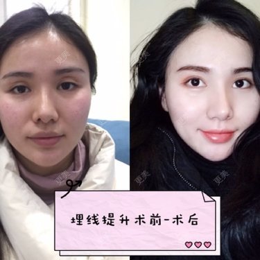 热玛吉