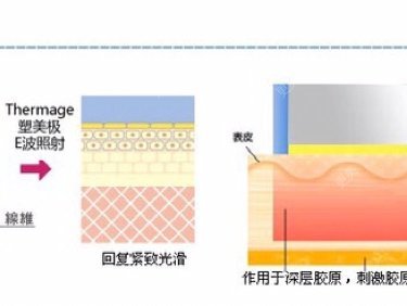 热玛吉