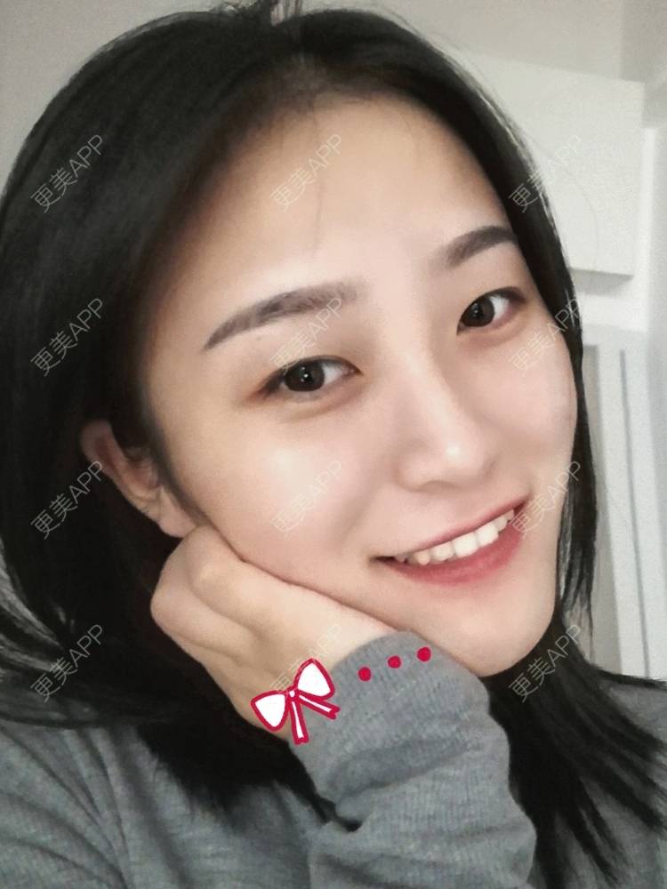 更美 - 欣欣的后花园的激光淡斑经验 | 皮秒激光 | 激光淡斑 | 武汉